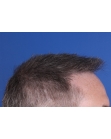 After Hair Transplant&nbsp;2 Sessions (Areas)